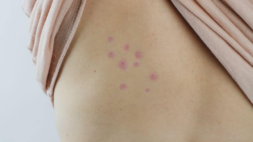 Punture da cimici da letto sulla schiena di una ragazza